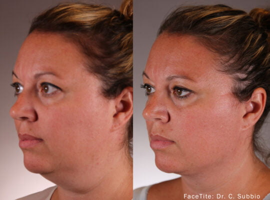 CS-1a-FaceTite-Left-Front