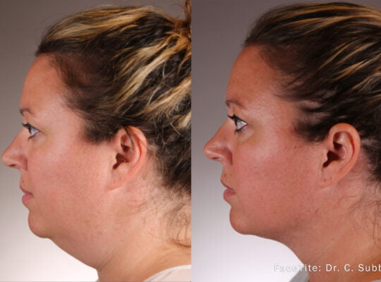 CS-1a-FaceTite-Left-Side