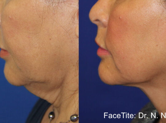 FaceTite-NN-Neck-Treament-scaled