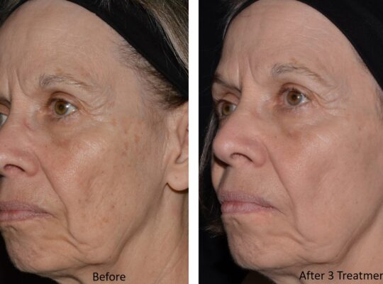 Ultra_Loverme Rejuvenation_Pigment 1