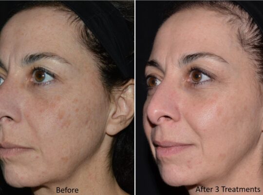 Ultra_Loverme Rejuvenation_Pigment 4 Left