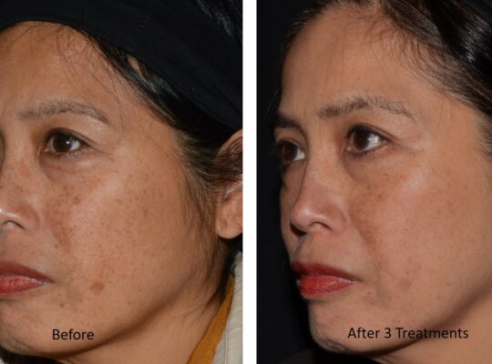 Ultra_Loverme Rejuvenation_Pigment 6 Left