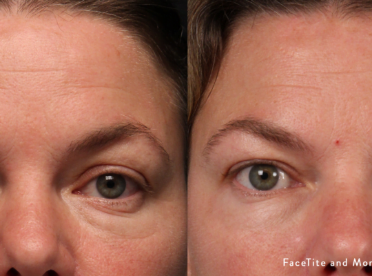 facetite-and-morpheus8-before-after-dr-m-clifton-preview-1