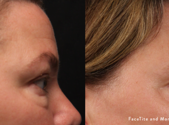 facetite-and-morpheus8-before-after-dr-m-clifton-preview-5