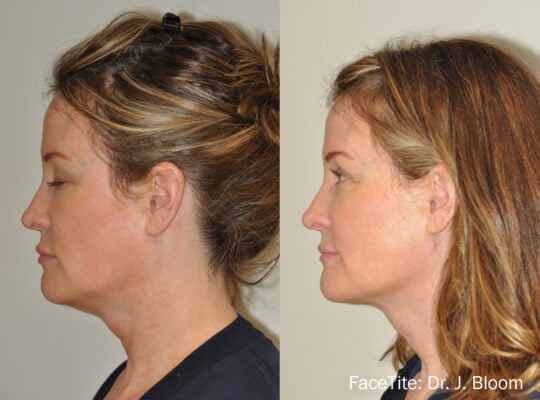 facetite-before-after-dr-j-bloom-preview-5