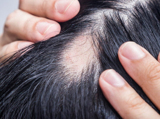 caderea parului