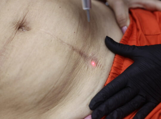 Tratament cicatrici mures